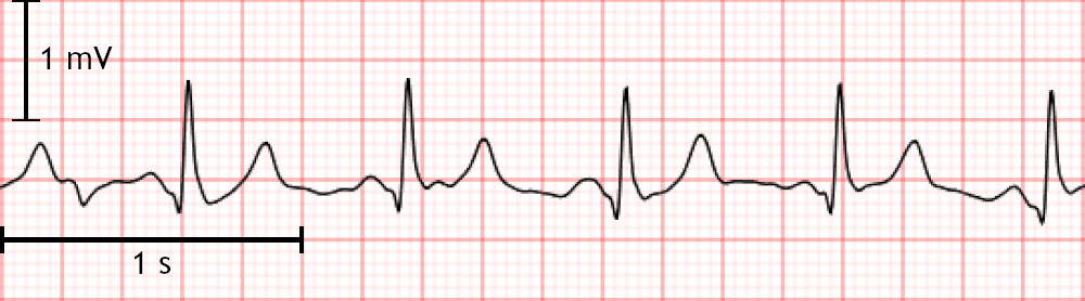 Segnale ECG